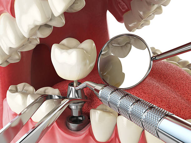 Tooth Infection Emergency Dentist in GA